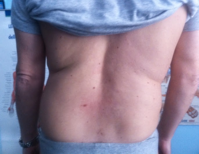 Schiena prima del trattamento di Terapia Manuale Osteopatica
